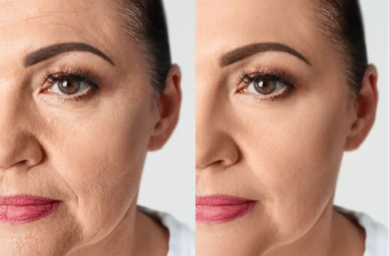 Tratamento de Bioestimuladores de Colágeno na Cairós Prime Clinic